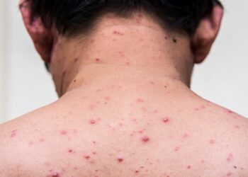 Kontak Seksual jadi Media Penularan Cacar Monyet