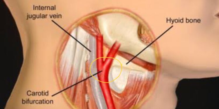 Benarkah Ciuman Cupang Bisa Picu Strok?