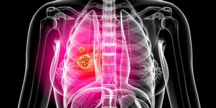 Waspada Kanker Paru Jika Batuk tak Kunjung Sembuh