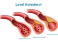 Segera Periksa Jika Tubuh Kelebihan Kolesterol, Ini Gejalanya!