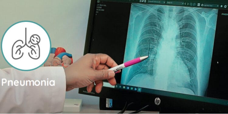 Bisa Fatal Jika Dibiarkan, Ketahui Gejala Awal Pneumonia