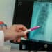 Bisa Fatal Jika Dibiarkan, Ketahui Gejala Awal Pneumonia