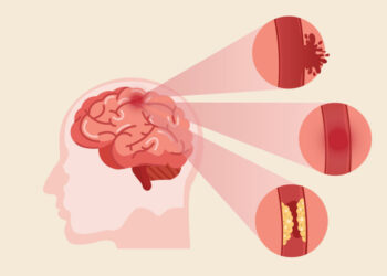 Cegah Stroke dengan tak Begadang dan Aktif Olahraga