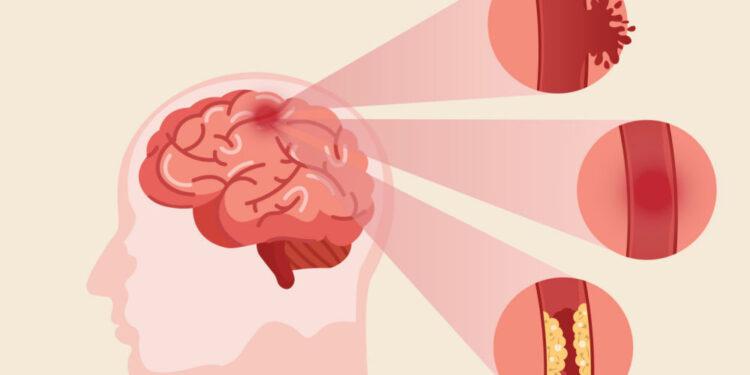 Cegah Stroke dengan tak Begadang dan Aktif Olahraga