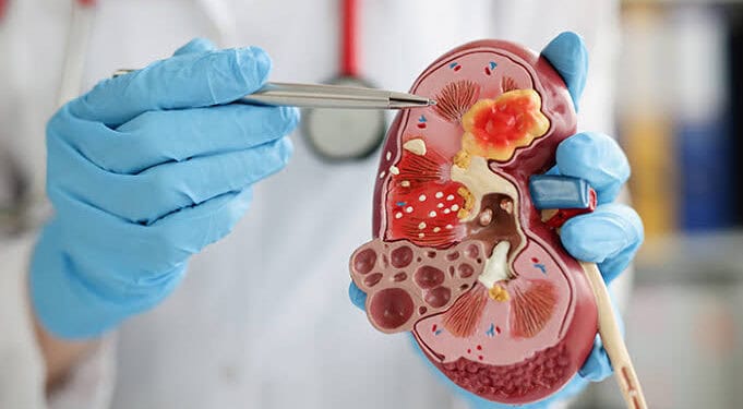 Masalah Ginjal yang Paling Tinggi Disebabkan Diabetes