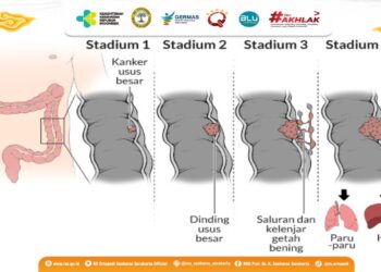 Waspada Kanker Usus Makin Banyak Serang Usia Muda