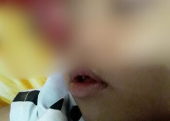 Karina Putri, Balita Asal Sukamakmur Berjuang Melawan Kanker Ganas Retina, Butuh Uluran Tangan Kita Semua