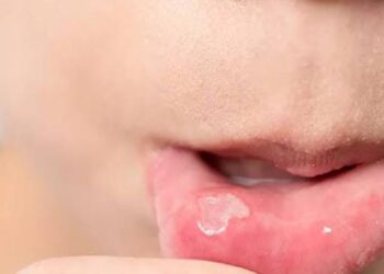 7 Cara Mengatasi Panas Dalam saat Puasa Ramadan