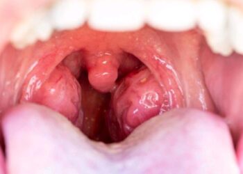 Berikut Panduan Pola Makan untuk Penderita Amandel